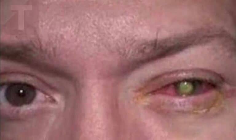 Έχασε την όρασή του εξαιτίας ενός νυχτερινού λάθους