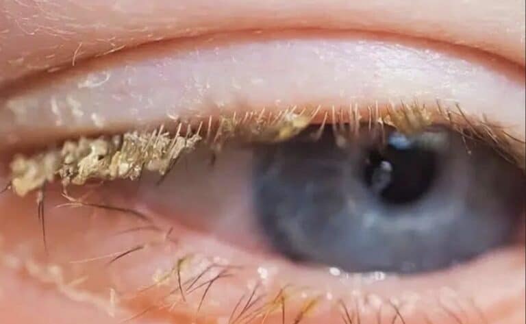 Οι άνθρωποι αναστατώθηκαν όταν συνειδητοποίησαν τι πραγματικά είναι η κίτρινη ουσία στα μάτια σου όταν ξυπνάς