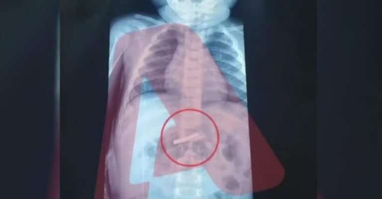 Στο νοσοκομείο Παίδων 3χρονο αγόρι – Τι σοκαριστικό κατάπιε 