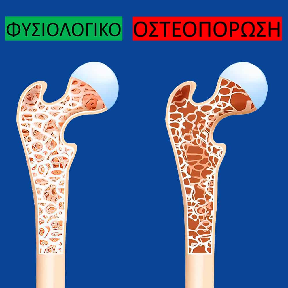 fysiologiko osto vs osteoporosi