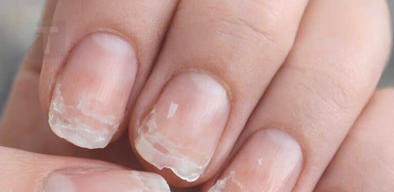 Τα νύχια σας σπάνε ή ξεφλουδίζουν συχνά; Να τι προσπαθεί να σας πει το σώμα σας