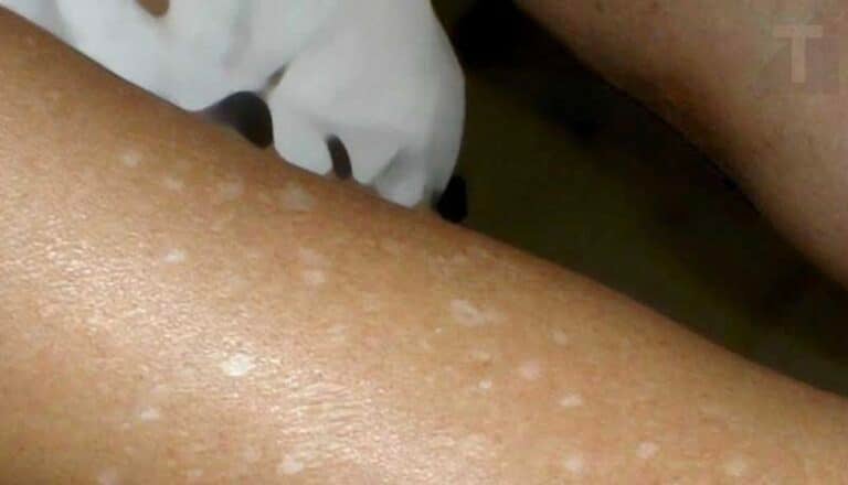 Γιατί εμφανίζονται μικρές λευκές κηλίδες στο δέρμα σας