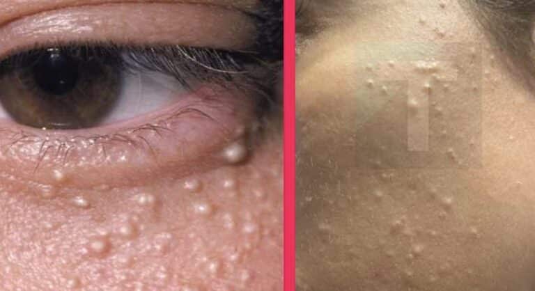 Γιατί εμφανίζονται μικρά λευκά σπυράκια στο πρόσωπο