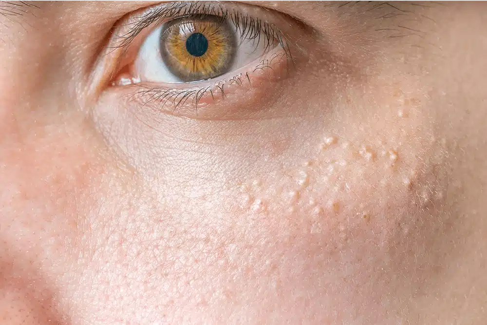 what is milia and how to handle milia