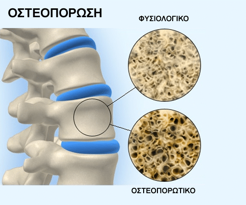 osteoporosis2