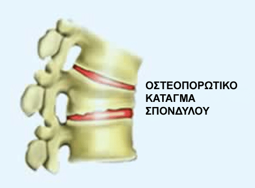 osteoporotic fracture1