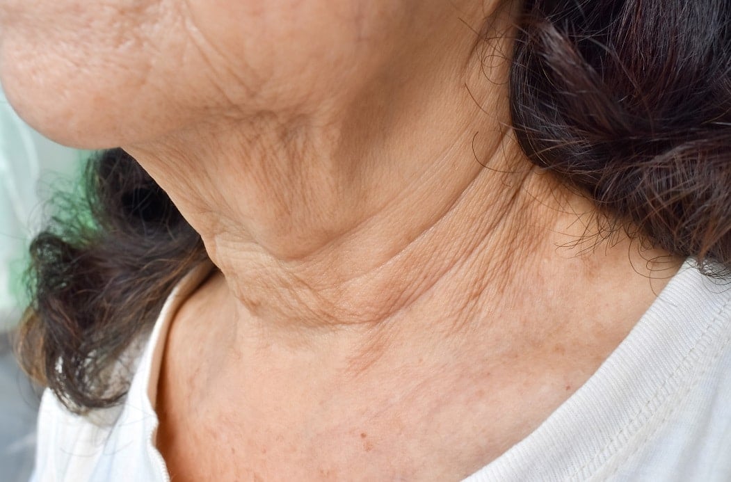 sagging neck skin showing fine lines creases and loss of firmness due to ageing