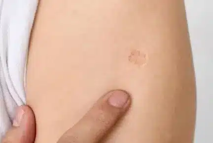 bcg scar pic4