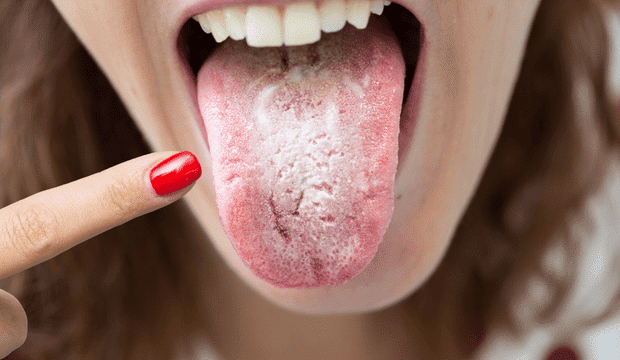 white tongue