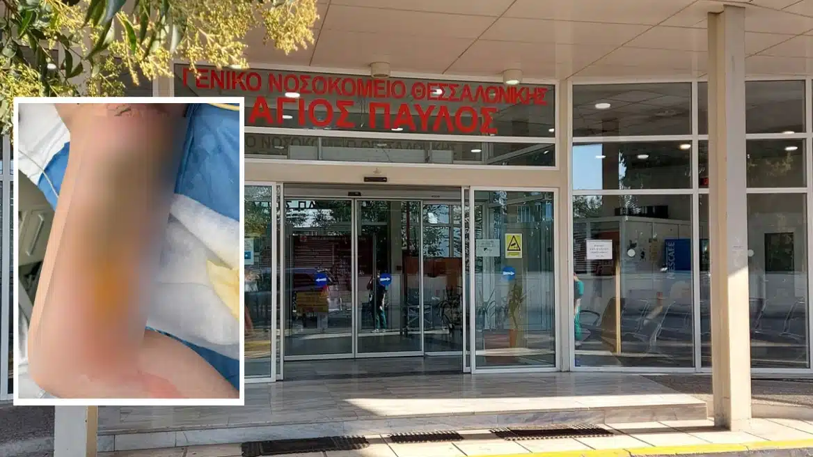 Σοκ σε ελληνικό νοσοκομείο με 20χρονη - Μπήκε για επέμβαση και έφυγε με εγκαύματα τρίτου βαθμού 1 maketa agios paulos egkaumata