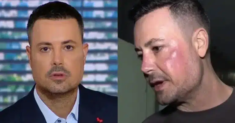 Πέτρος Κουσουλός: Τι είναι η γυροειδής αλωπεκία που τον ταλαιπωρεί – Η μάχη με το αυτοάνοσο και η νέα διάγνωση