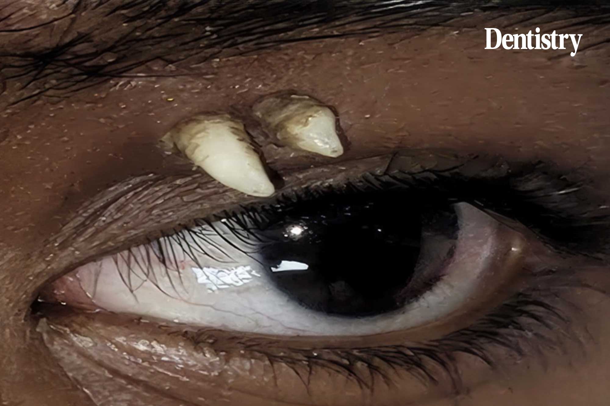 ectopic teeth