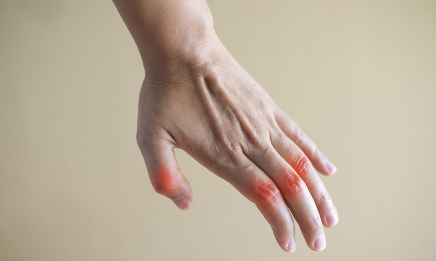 rheumatoid arthr